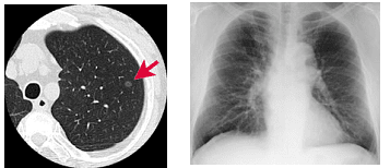 肺CT検診で早期の肺癌が見つかった患者さんの検査画像