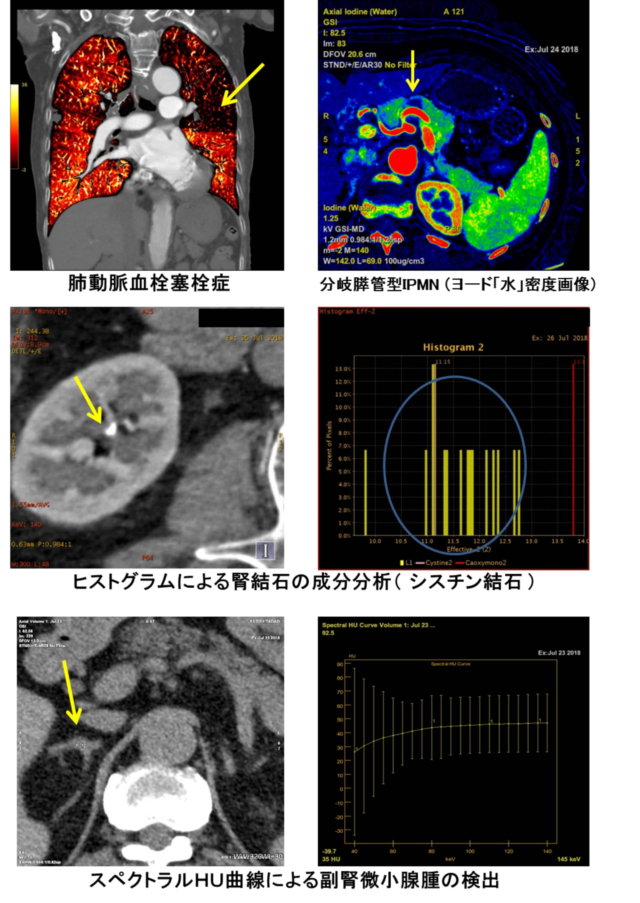 DUAL ENERGY CTによる画像診断の例